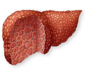 End Stage Liver Failure