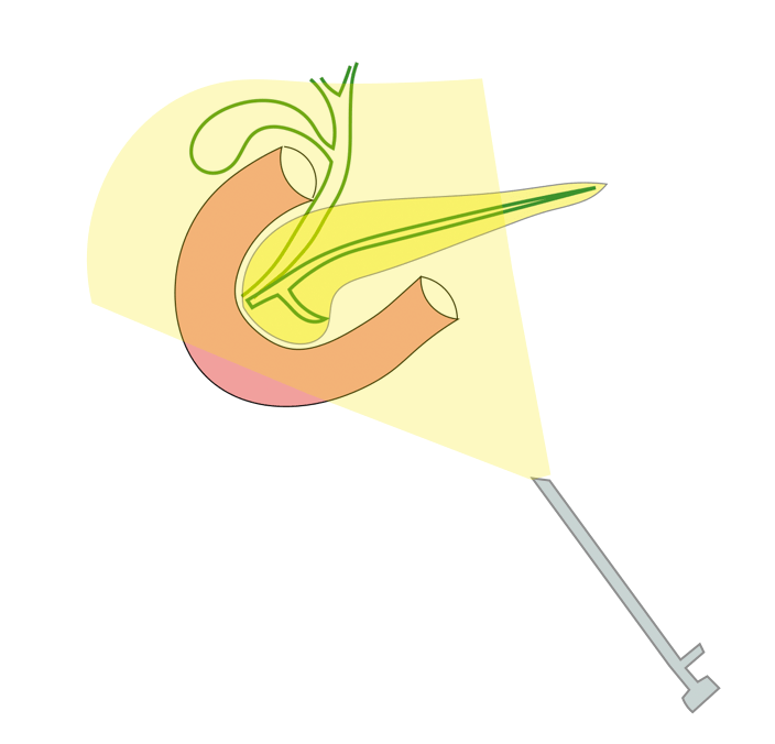 Minimally Invasive Pancreato-biliary Surgery